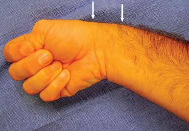 Fig. 67.3, The Finkelstein test demonstrated with thumb grasped in the palm with ulnar deviation of the wrist. The elbow should be in extension.