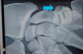 Fig. 67.4, (A) Posteroanterior x-ray of the wrist demonstrating a malunited trapezial ridge fracture (blue arrow) . (B) Magnetic resonance imaging demonstrating a flexor carpi radialis rupture from a malunited trapezial ridge fracture.