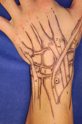 Fig. 67.5, Illustrated surface anatomy of the dorsal quadrant. * , Lister's tubercle. #, Scapholunate interval. 1, First dorsal compartment (APL and EPB). 2, Second dorsal compartment (ECRL and ECRB) and location of intersection syndrome. 3, Third dorsal compartment (EPL); the fourth and fifth compartments have been omitted for clarity. 4, Sixth dorsal compartment (ECU). 5 , Lunate. 6 , Triquetrum. 7 , Insertion of ECRL and ECRB and location of carpal boss.