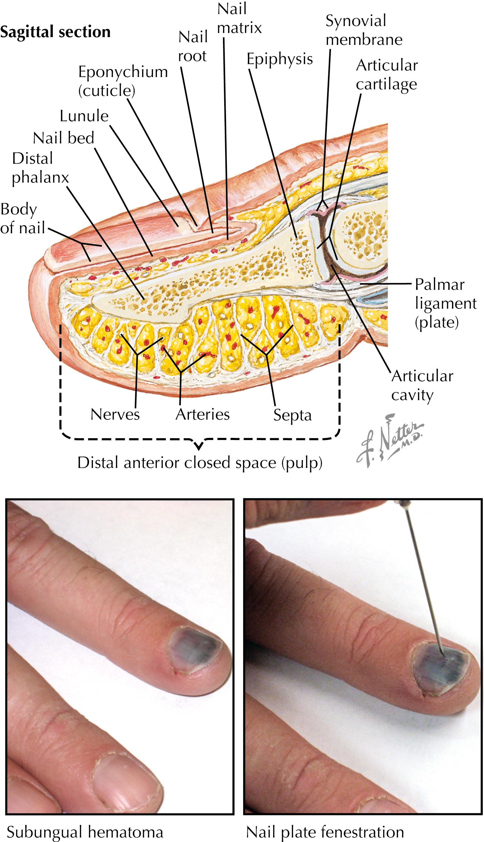 Figure 51.1, Nail bed injury.