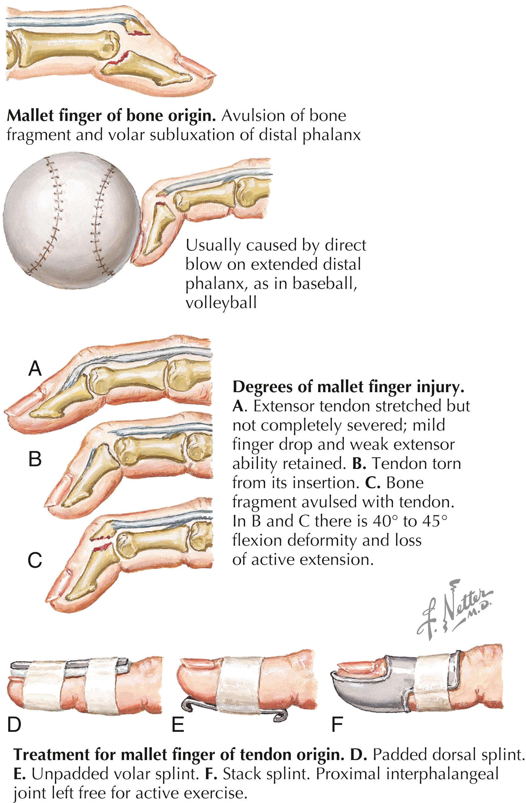 Figure 51.2, Mallet finger.