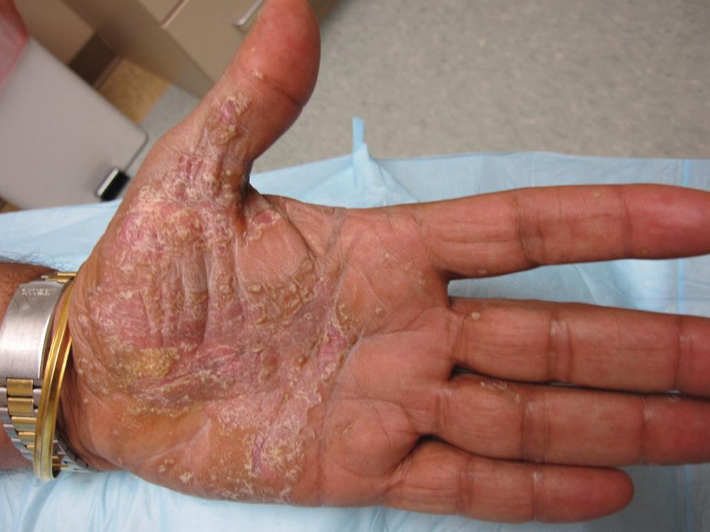 Fig. 4.2, Palmar Pustulosis, a Variant of Palmoplantar Psoriasis.