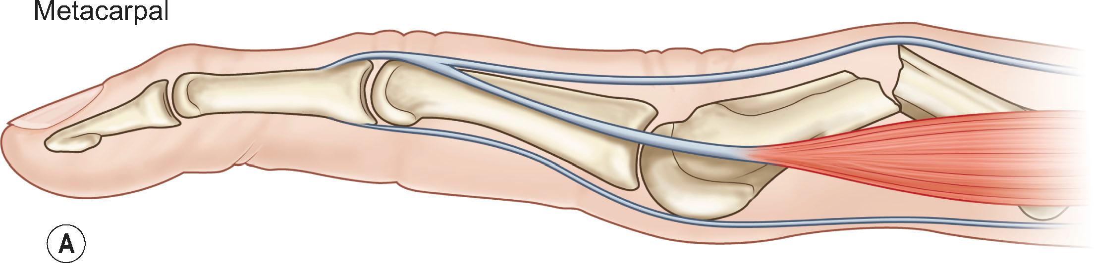 Figure 7.1, Angular deformity associated with fractures of the metacarpal and phalanges. (A) Metacarpal fractures typically have apex dorsal angulation secondary to the location of the interosseous muscles, while the proximal phalanx fractures (B) have an apex volar angulation. The angulation of middle phalanx fractures is dependent on the location of the fracture, relative to the insertion of the flexor digitorum superficialis tendon: fractures proximal to the insertion (C) will have apex dorsal angulation while those distal (D) will have apex volar angulation.