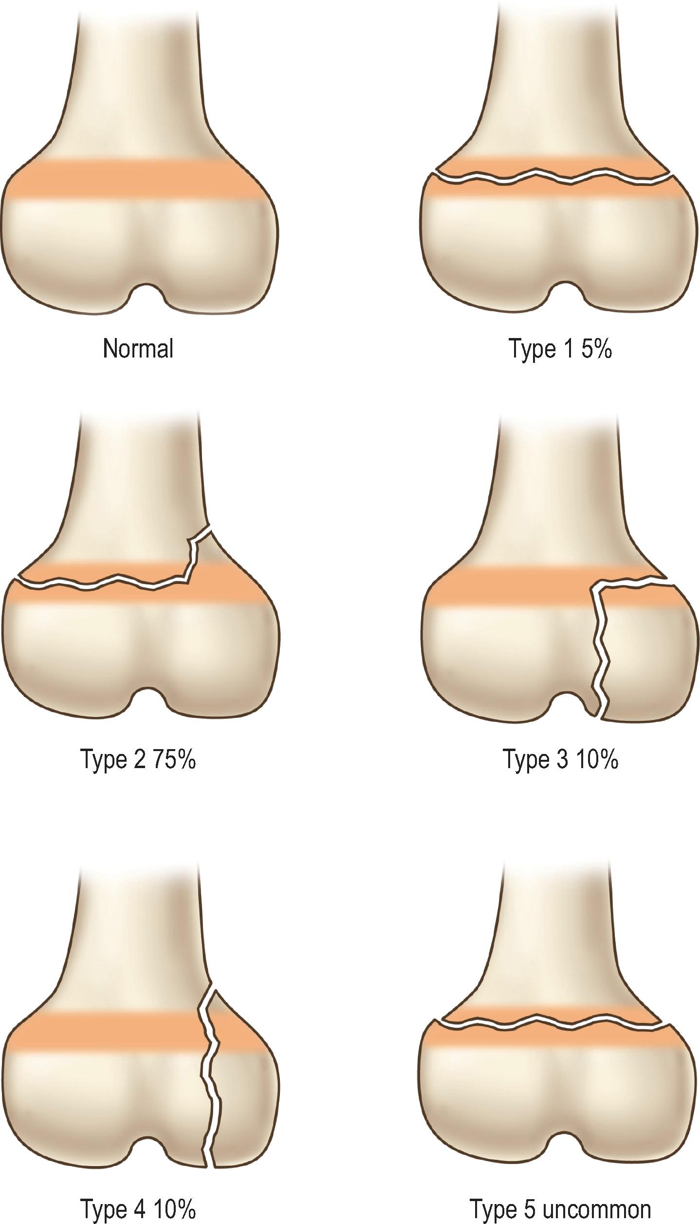 Figure 7.2, Classification of Salter–Harris fractures. Type 1 is through the physis. Type 2 extends from the physis toward the shaft. Type 3 extends from the physis toward the joint. Type 4 starts in the shaft and extends through the physis and into the joint. Type 5 is a crush injury of the physis.