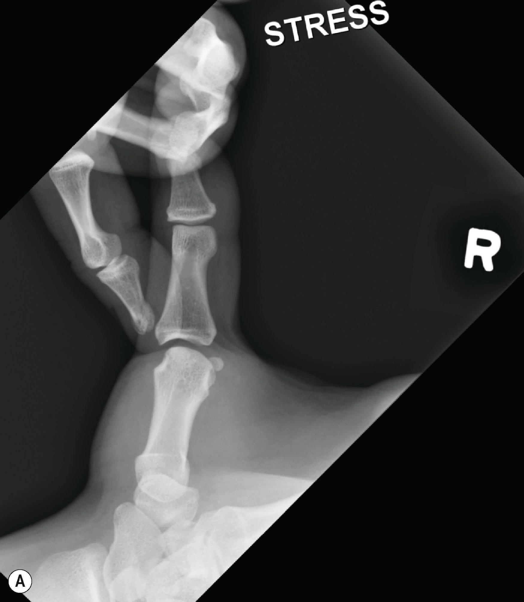 Figure 7.3, Stress view X-ray (A) and MRI (B) demonstrating thumb MCP joint ulnar collateral ligament injury.