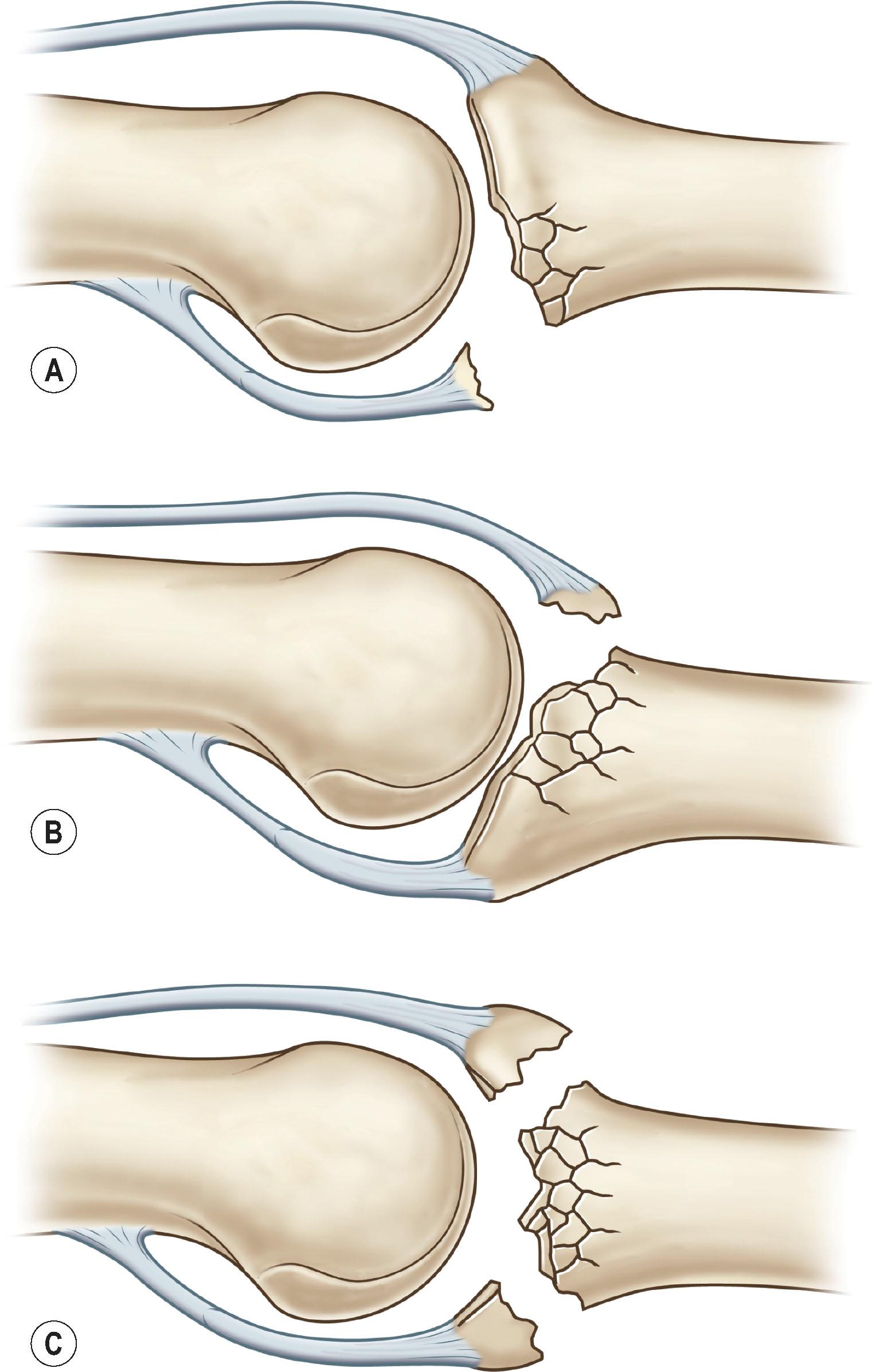 Figure 7.4, Classification of PIP joint fracture dislocations. (A) Volar base fracture resulting in dorsal subluxation of the middle phalanx. (B) Dorsal base fracture resulting in volar subluxation of the middle phalanx. (C) Pilon type fracture with dorsal and volar base fractures and comminuted, depressed central articular surface.