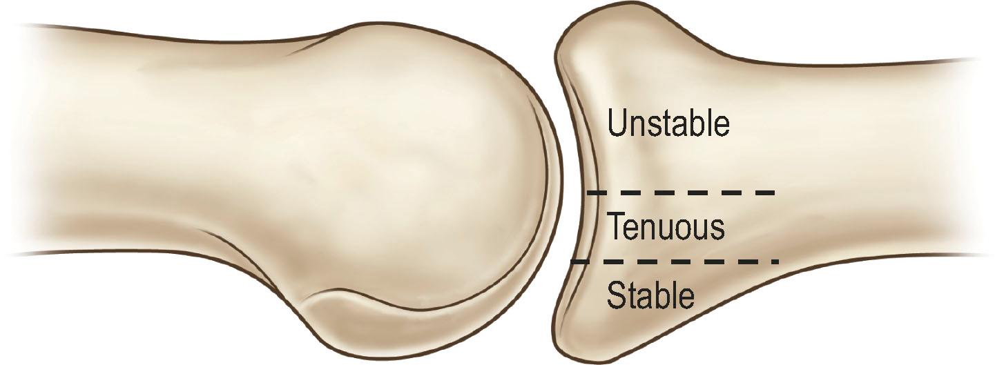 Figure 7.5, Stability of PIP fracture dislocations. Fractures involving <30% of the articular surface are typically stable. Those involving 30–50% are tenuous and those involving >50% are unstable and have resultant dorsal subluxation.