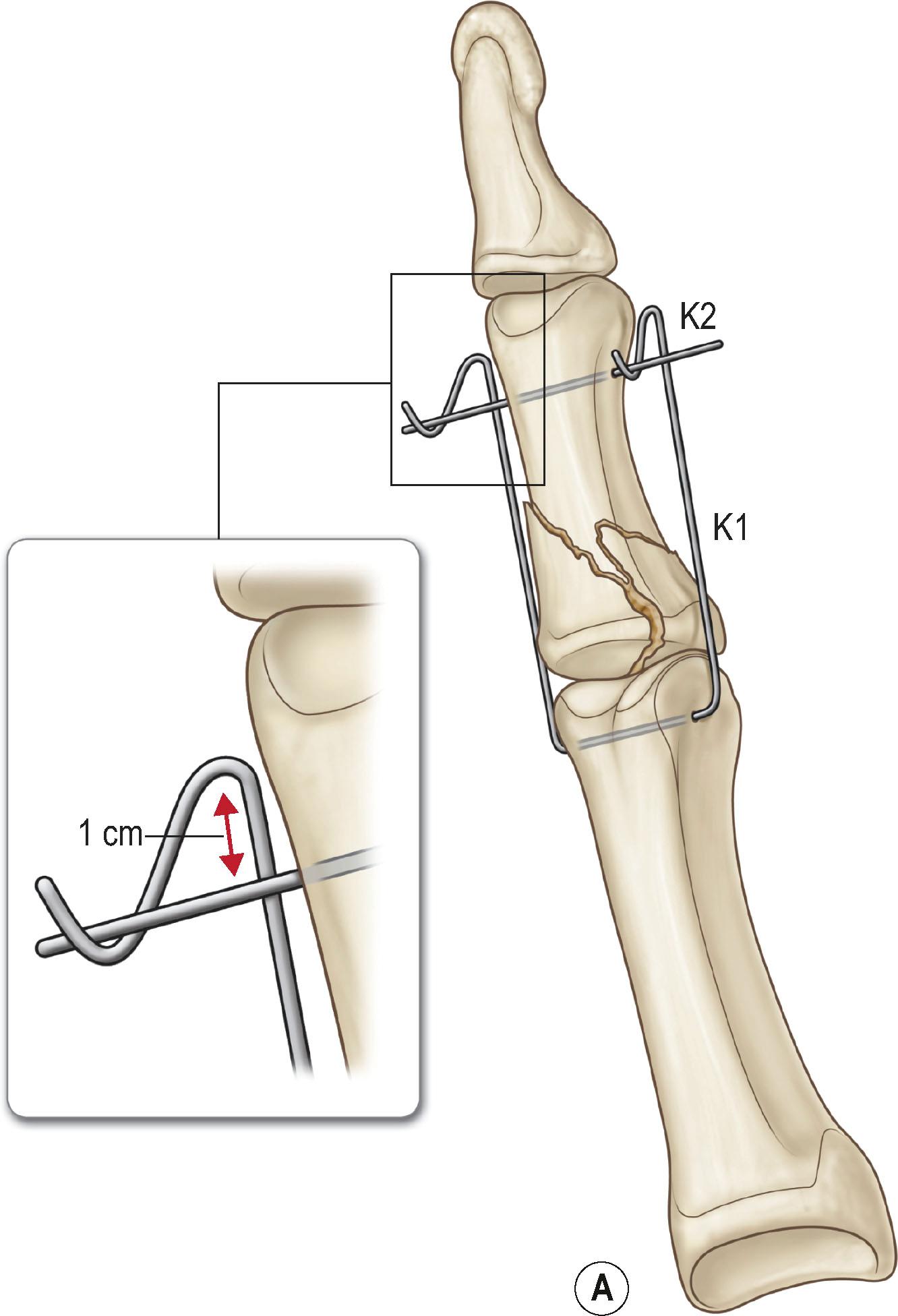 Figure 7.7, (A) Fabrication of external fixator from K-wires. (B) Preoperative radiograph of PIP fracture dislocation involving the small finger. (C) Radiograph with external fixator in place, allowing motion. (D) Postoperative results in flexion.