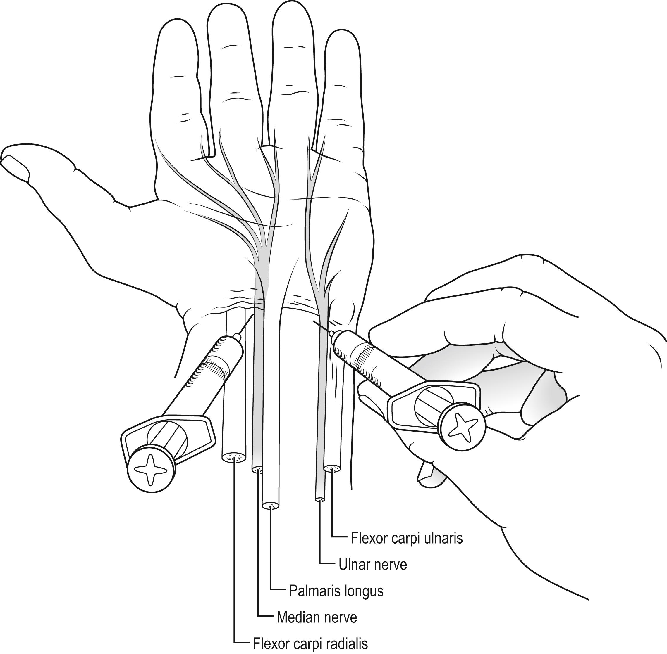 Fig. 4.5.1, Palmar wrist block.