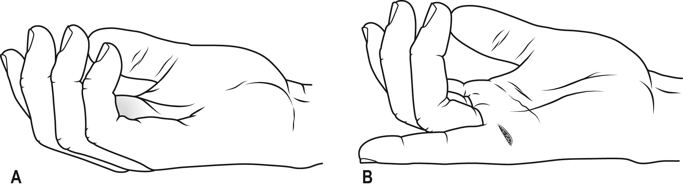 Fig. 4.5.2, (A) The normal resting hand. (B) The pointing finger.