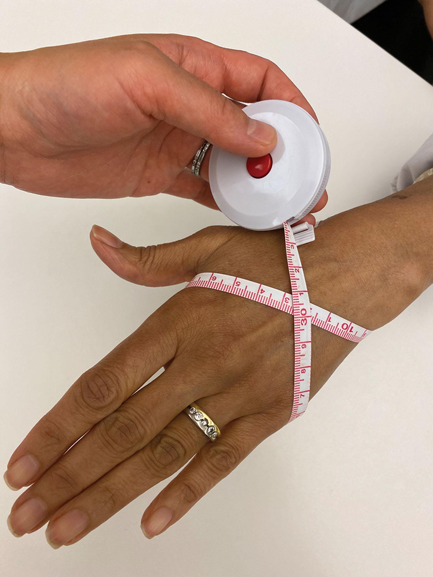Figure 43.1, The figure-of-eight measurement technique for assessing edema is performed using a tape measure that is started at the base of the scaphoid and wrapped ulnar across the distal wrist crease, distal and oblique across the dorsum of the hand toward the second metacarpal, along the palmar digital crease in an ulnar direction to the fifth digit and back across the dorsum of the hand to the starting point.