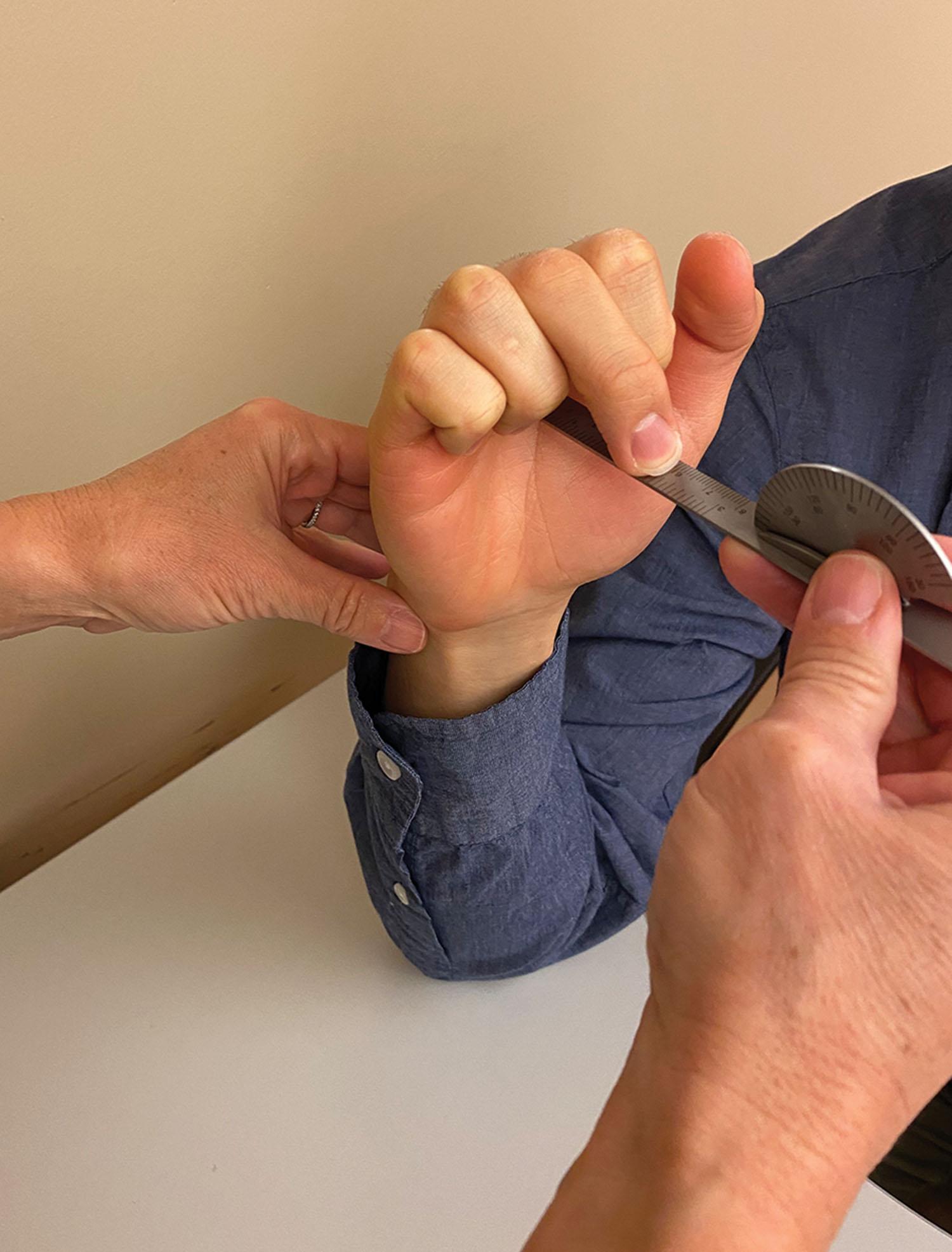 Figure 43.2, To measure composite finger flexion, the goniometer is placed perpendicular to the distal palmar crease (DPC). The patient is asked to bring their fingers into a full fist position attempting to touch the palm of their hand. Each digit is measured as the distance from finger pulp to DPC with 0 indicating full composite flexion of the digit.