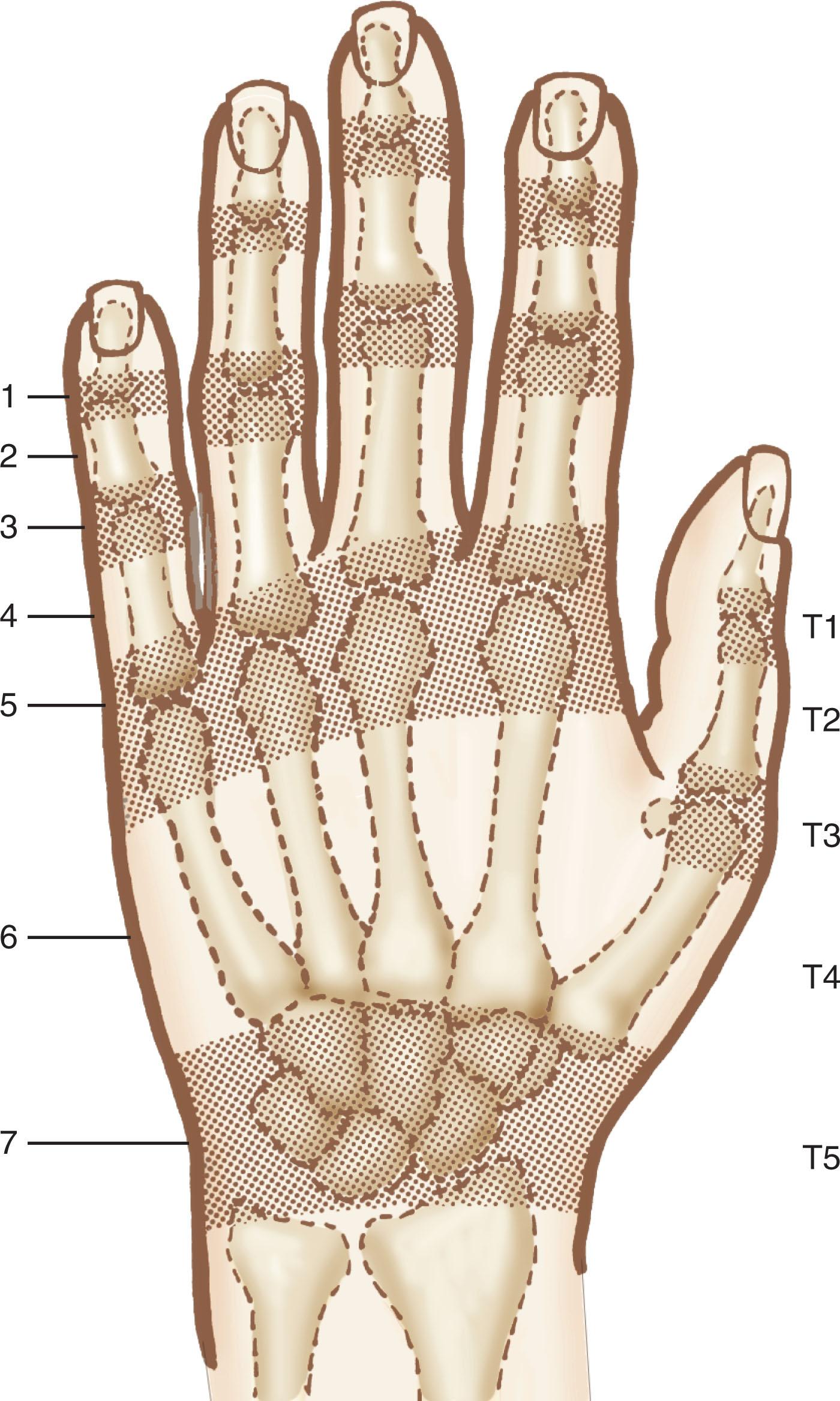 Figure 43.3, Extensor tendon zones of the digits and thumb.