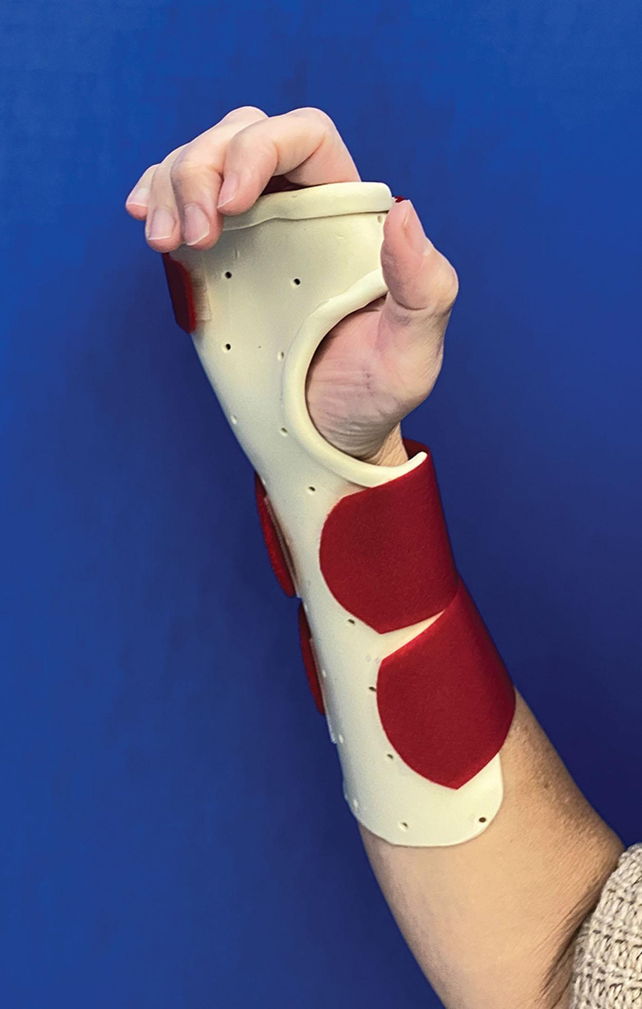 Figure 43.5, A static extension orthosis immobilizing the wrist and metacarpal phalangeal joints while allowing the interphalangeal joints to be free may prevent finger stiffness.