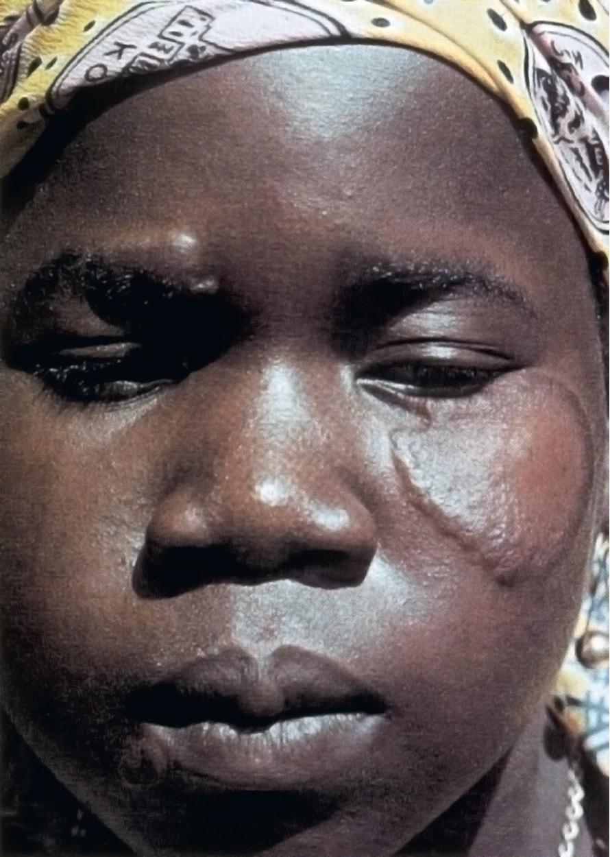 Fig. 243.1, Tuberculous leprosy in a patient who has a single skin lesion with a raised border and flattened center.