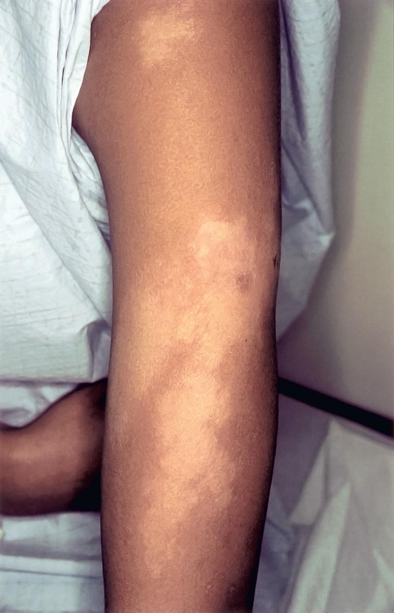 Fig. 243.2, Borderline leprosy in a patient who has numerous, hypopigmented lesions with poorly defined borders.