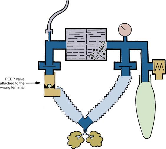 Fig. 23.15, Schematic illustrating erroneous insertion of a weighted ball design positive end-expiratory pressure (PEEP) valve on an inspiratory port. This causes complete obstruction to inspiration.