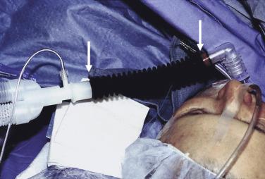 Fig. 23.10, Insertion of “goose neck” connection (white arrows) between Y-piece and patient’s airway increases apparatus (mechanical) dead space.