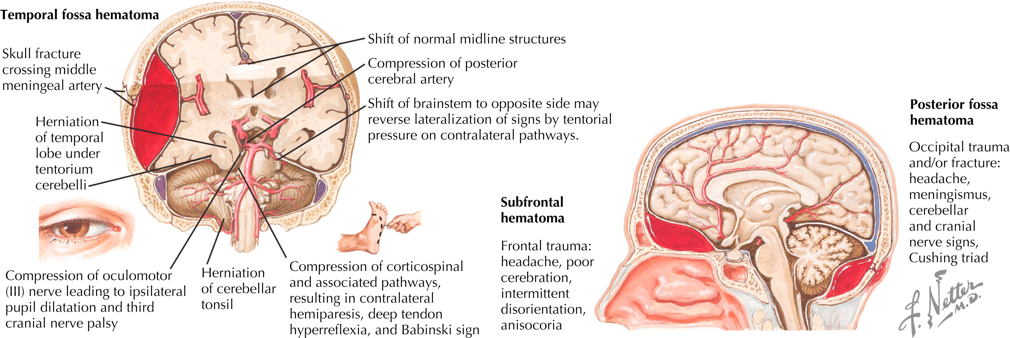 Figure 45.2, Epidural hematoma.