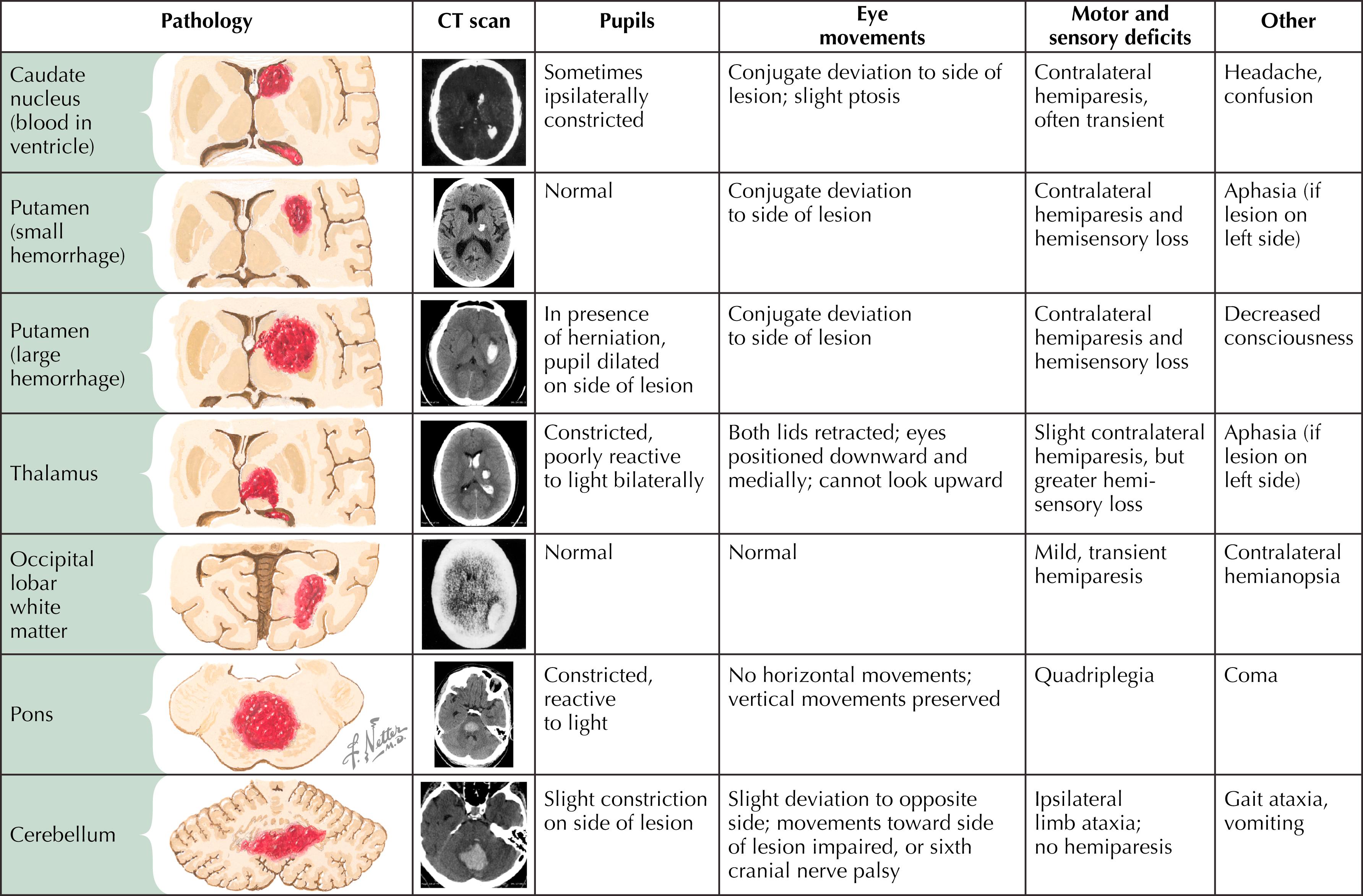 Figure 45.3, Intracerebral hemorrhage: Clinical manifestations related to site.