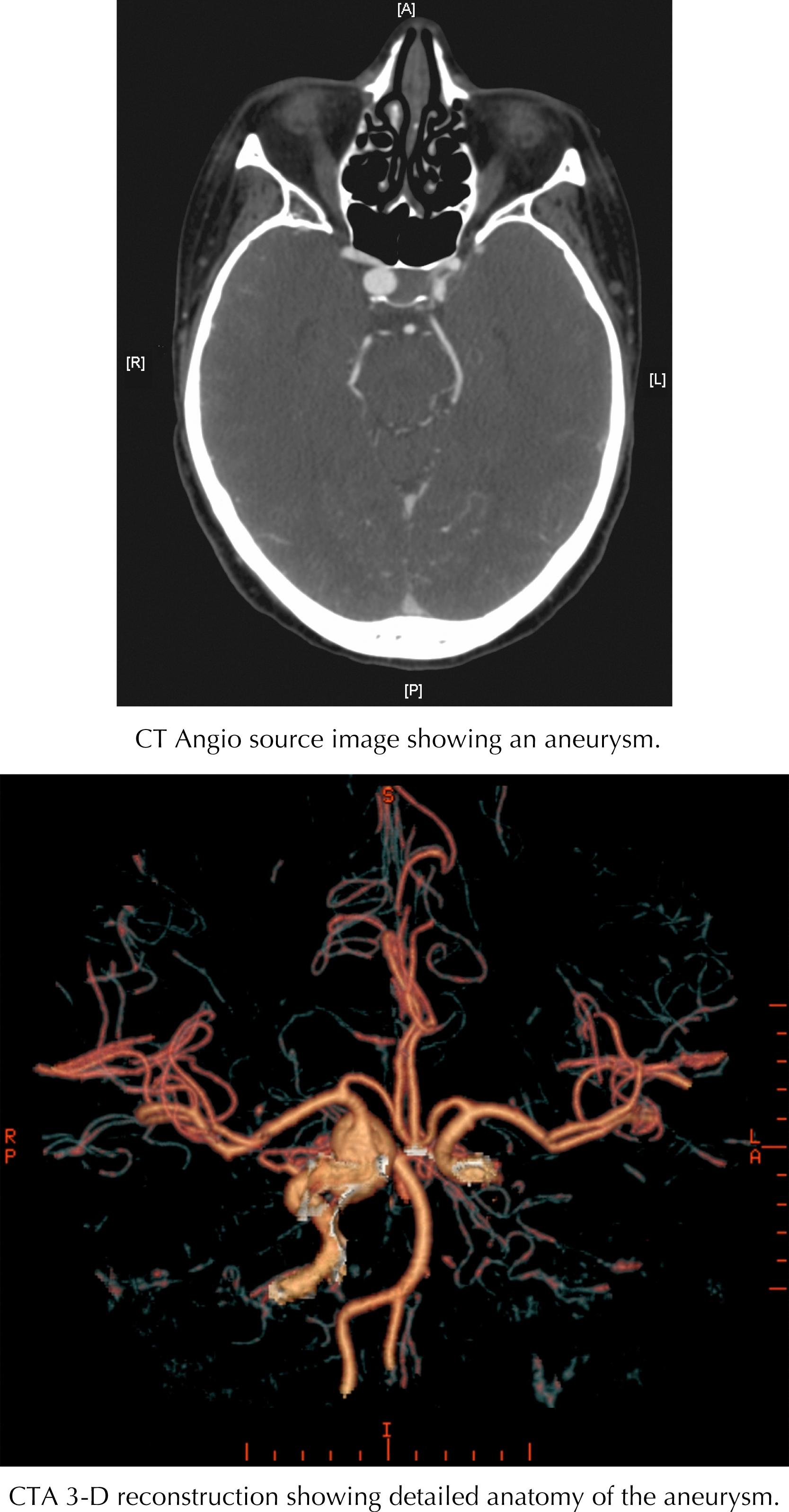 Figure 45.4, Subarachnoid hemorrhage.