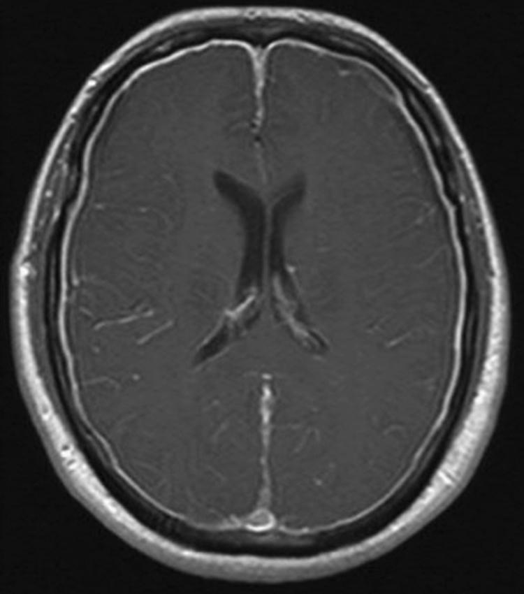 Fig. 102.1, Axial T1-weighted magnetic resonance image with gadolinium in a patient with a spontaneous spinal cerebrospinal fluid leak and orthostatic headache demonstrates diffuse pachymeningeal thickening and enhancement.