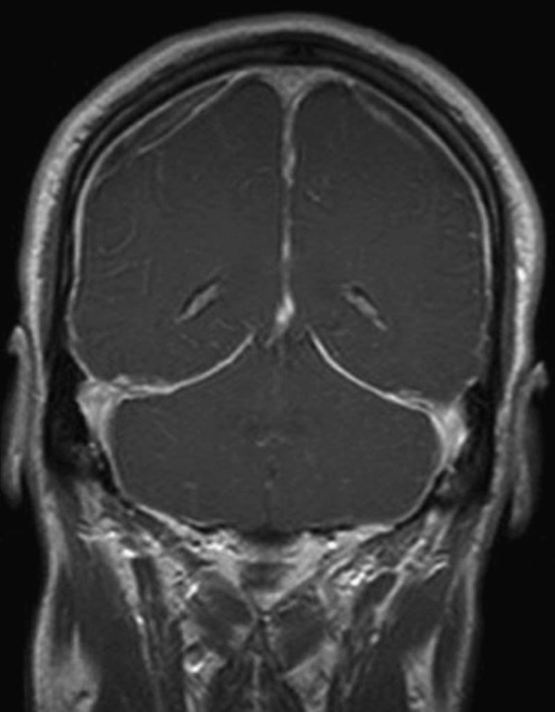 Fig. 102.2, Coronal T1-weighted magnetic resonance image with gadolinium of a patient with orthostatic headache secondary to a SSCSFL demonstrates subdural fluid collections and pachymeningeal enhancement.