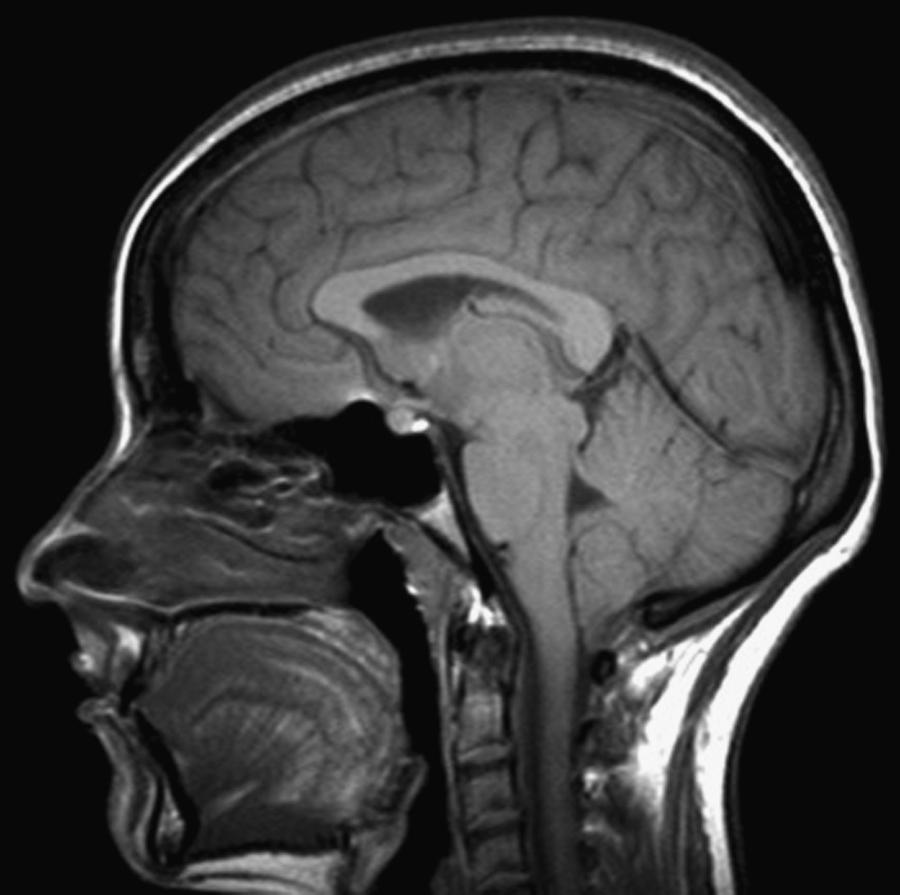 eFig. 102.3, Sagittal T1-weighted magnetic resonance image demonstrates brain descent made evident by low cerebellar tonsils, crowding of the posterior fossa, small prepontine cistern, and inferior displacement of the optic chiasm in a patient with a SSCSFL.