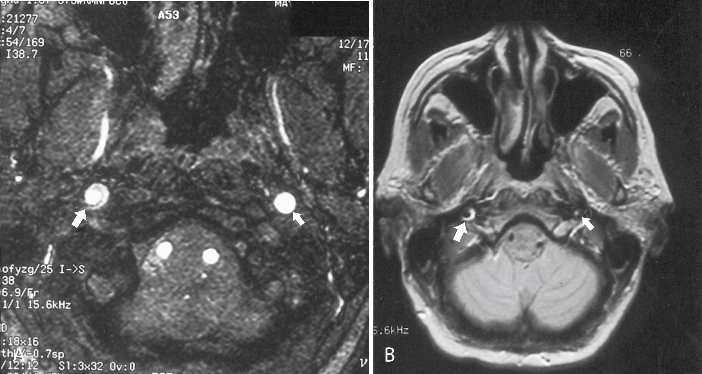 eFig. 102.4, Magnetic resonance images of a patient with right internal carotid artery (ICA) dissection. Large arrow in each figure points to right ICA, which has a smaller flow void than left ICA (small arrows) , reflecting narrowed vessel lumen. Region of flow void is surrounded by a hyperintense crescent representing the intramural hematoma.