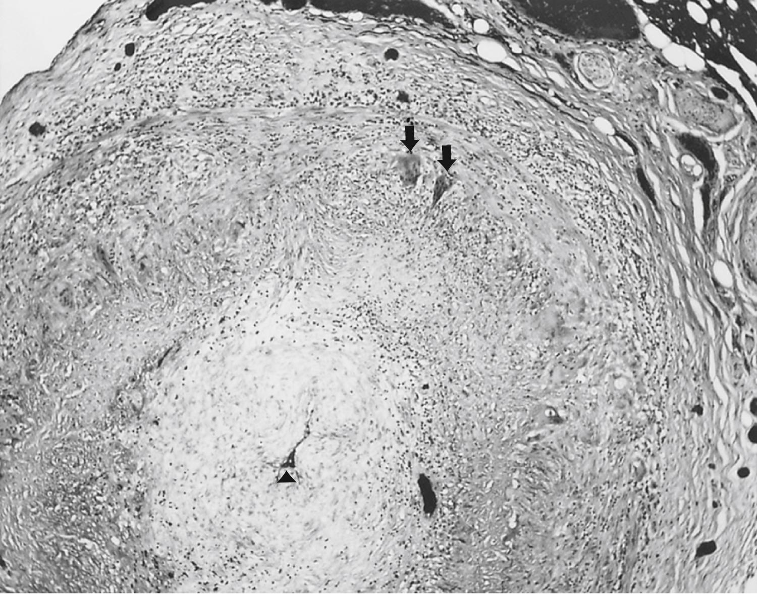 eFig. 102.5, Transverse section of temporal artery showing narrowed lumen (arrowhead) and giant cells (two arrows ) in relation to the elastic lamina (hematoxylin and eosin stain, ×100)