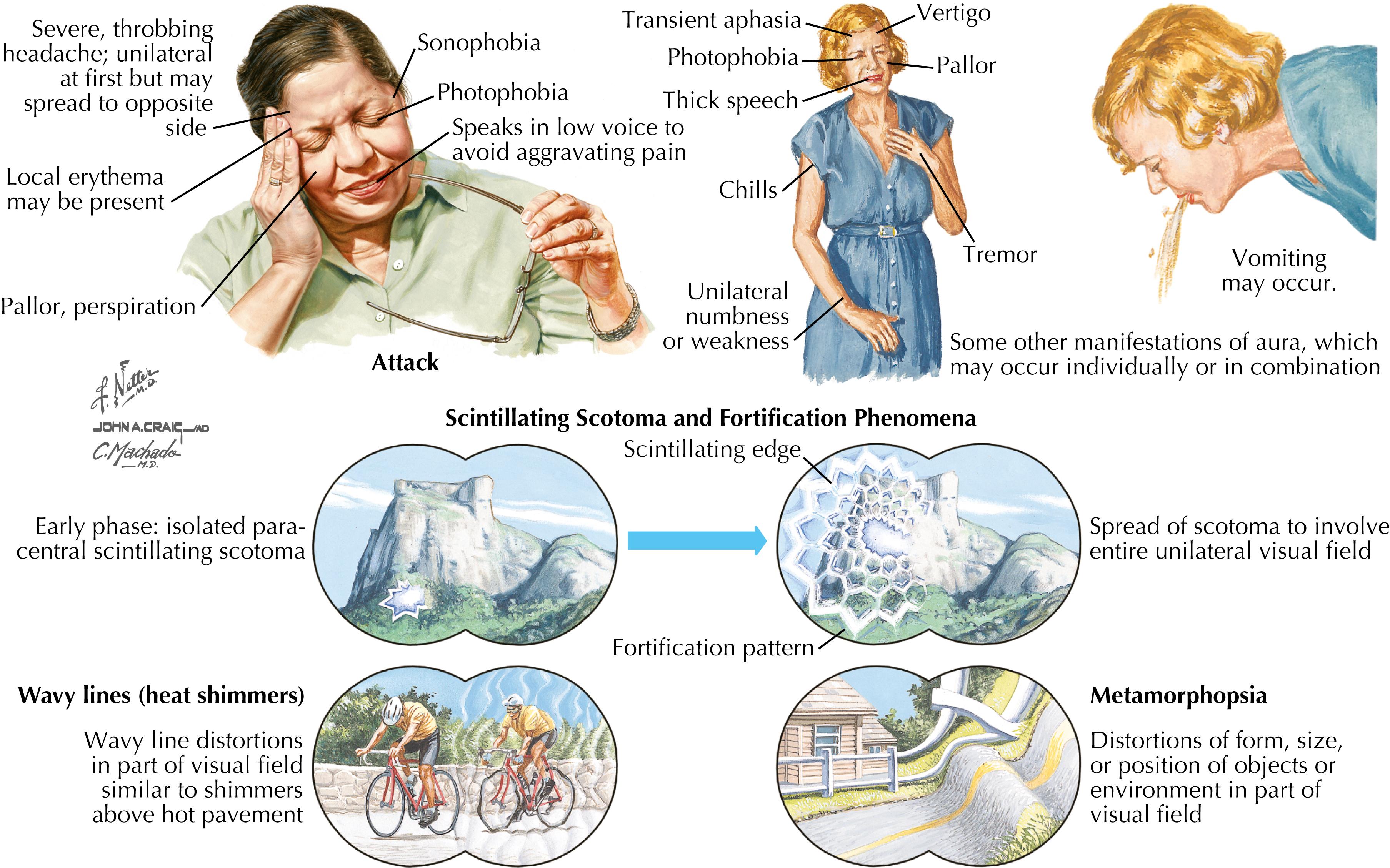 Figure 39.1, Mechanisms of migraine.