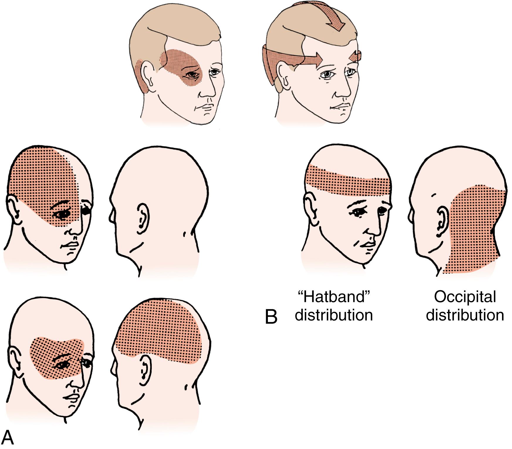 Fig. 34.1, Common location of migraine (A) and tension (B) headaches. Of note, some tension headaches may be unilateral, while migraines may occur in the same distribution (including bilateral) as tension headaches.