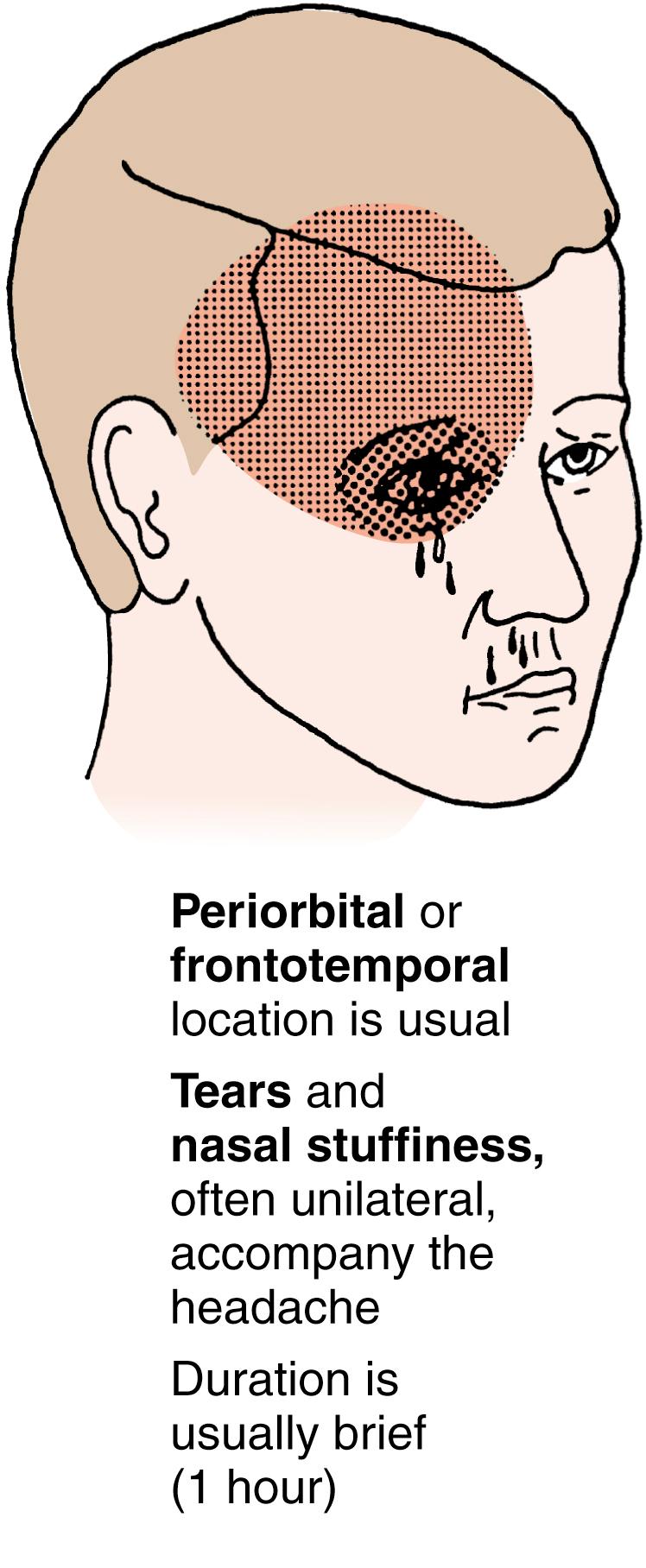 Fig. 34.3, Cluster headache.