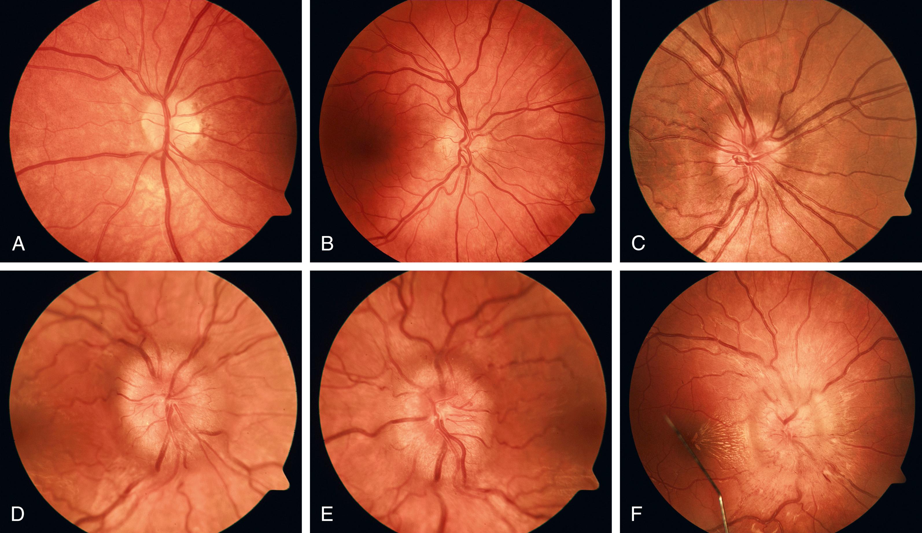 Fig. 34.4, Stages of papilledema (Frisen scale). A, Stage 0: normal optic disc. B, Stage 1: very early papilledema with obscuration of the nasal border of the disc only, without elevation of the disc borders. C, Stage 2: early papilledema showing obscuration of all borders, elevation of the nasal border, and a complete peripapillary halo. D, Stage 3: moderate papilledema with elevation of all borders, increased diameter of the optic nerve head, obscuration of vessels at the disc margin, and a peripapillary halo with finger-like extensions. E, Stage 4: marked papilledema characterized by elevation of the entire nerve head and total obscuration of a segment of a major blood vessel on the disc. F, Stage 5: severe papilledema with obscuration of all vessels and obliteration of the optic cup. Note also the nerve fiber layer hemorrhages and macular exudate.