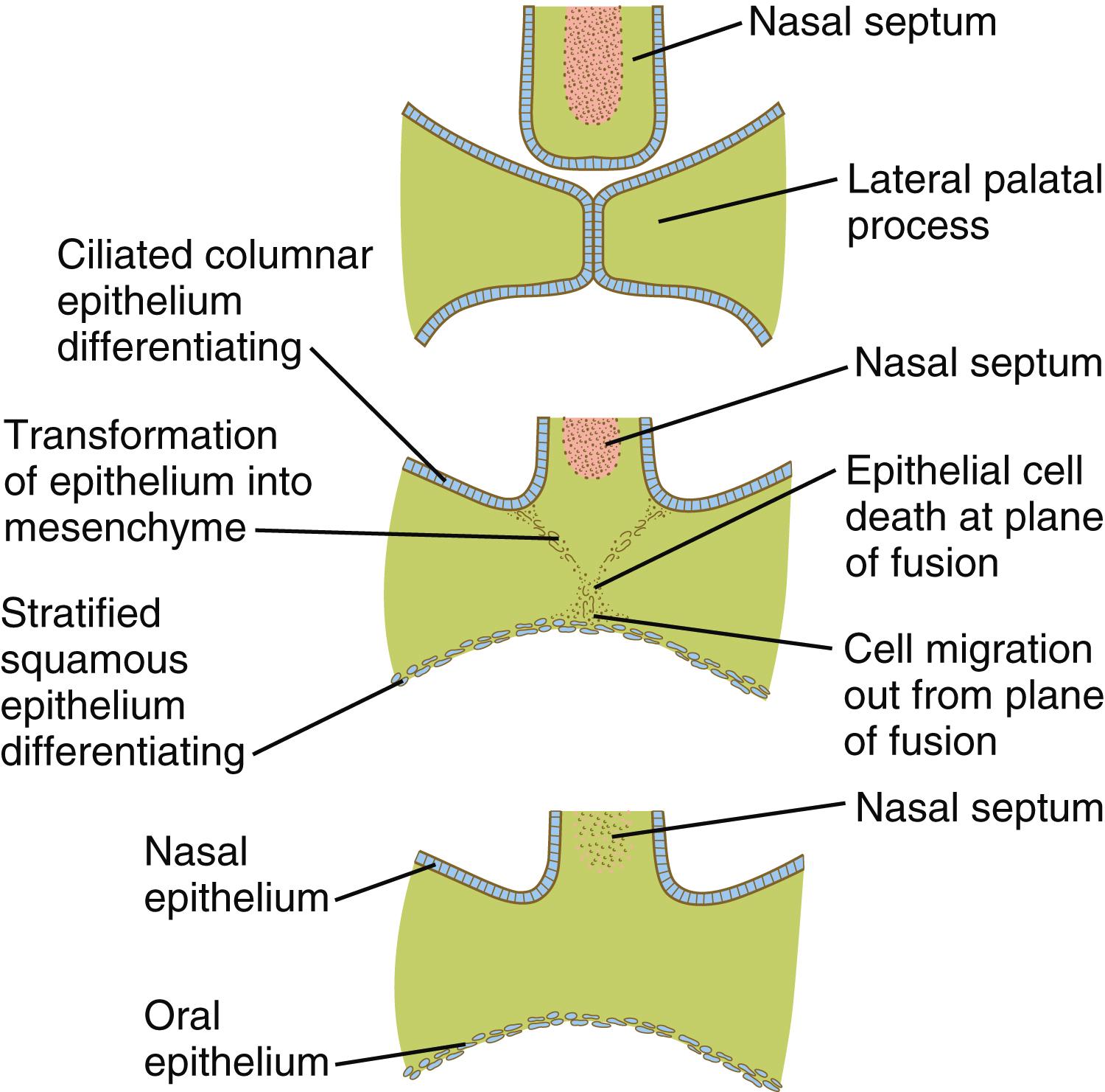Fig. 14.13, Developmental processes associated with fusion of the palatal shelves and the nasal septum.