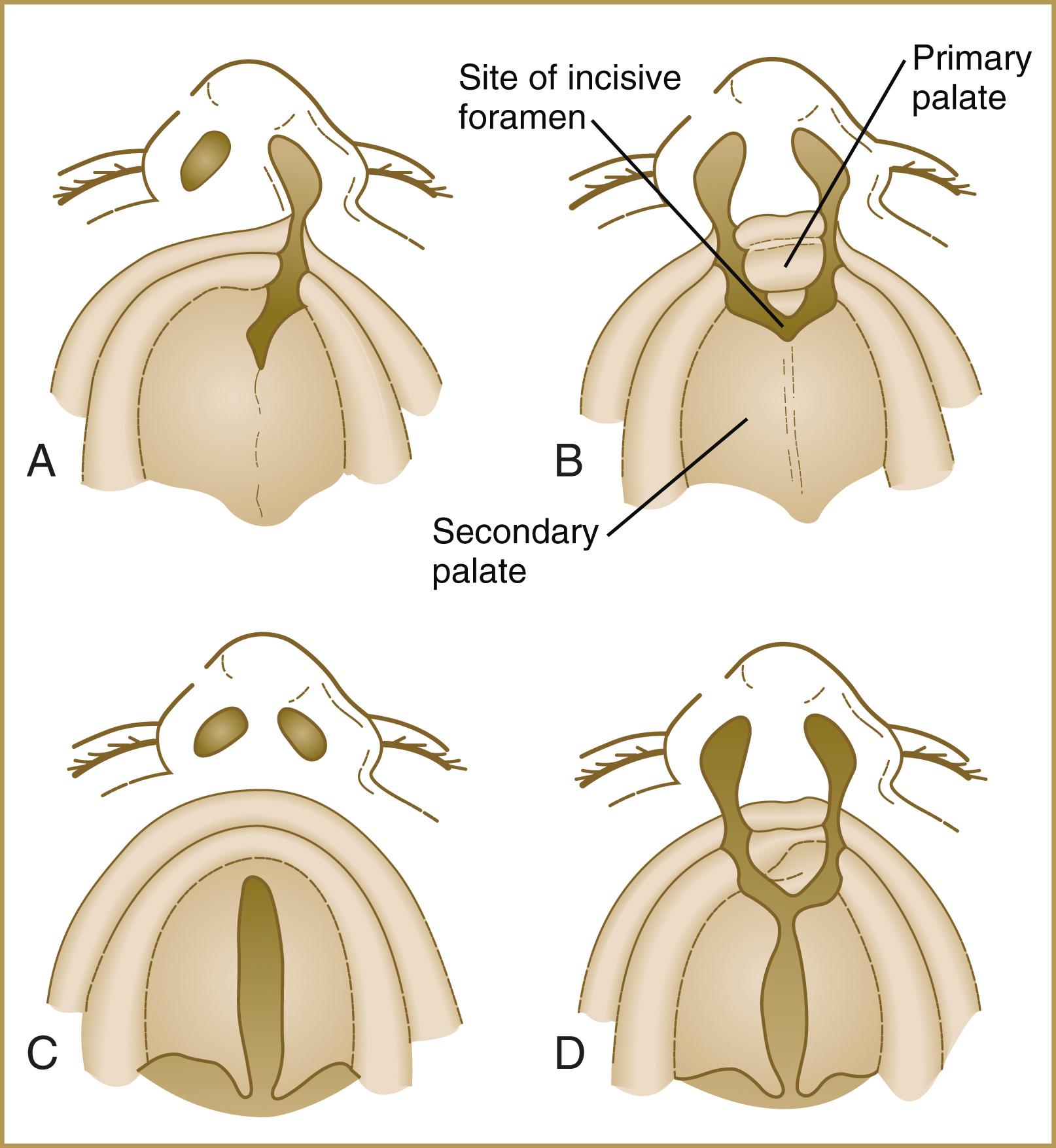 Fig. 14.17, Common varieties of cleft lip and palate.