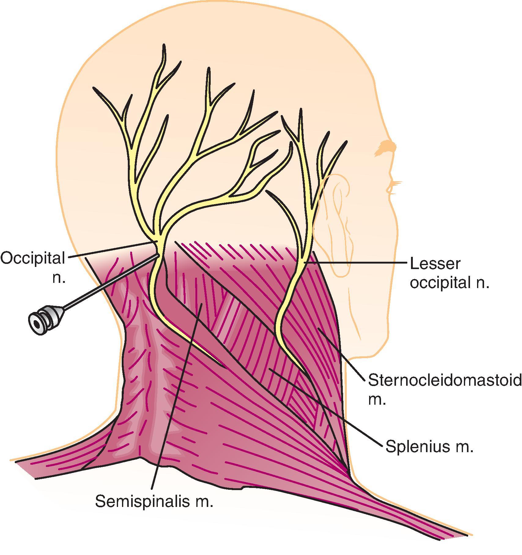 Figure 64.12, The anatomy and site of nerve blocking for the greater occipital nerve.