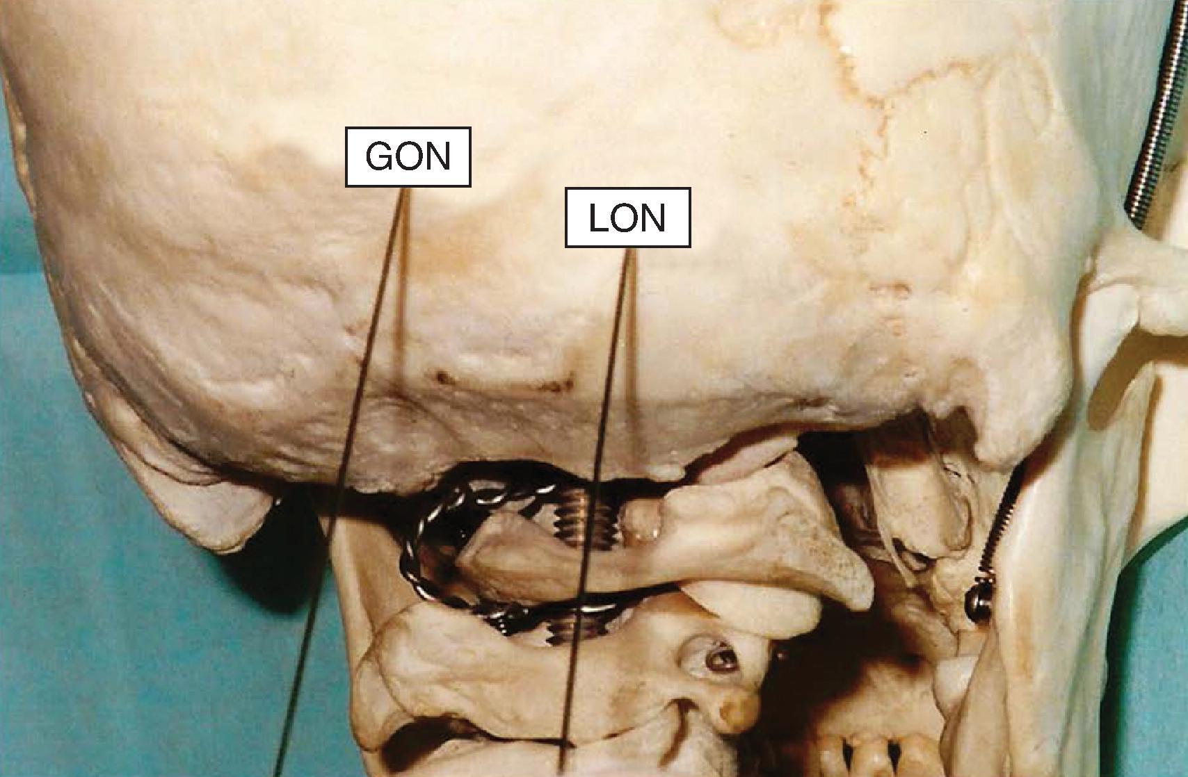 Figure 64.13, Needles inserted for right sided greater occipital nerve (GON) and lesser occipital nerve (LON) blocks. (Photo courtesy of Kenneth D. Candido, M.D.)