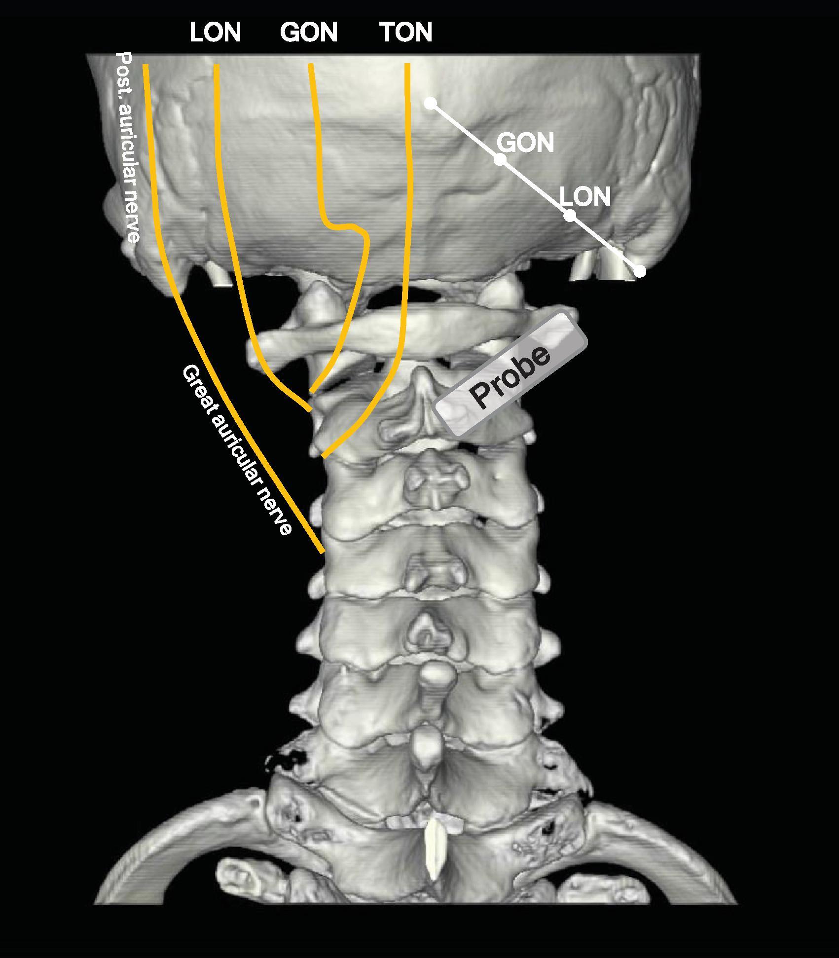 Figure 64.14, Schematic anatomy of the nerves in the occipital area. GON , Greater occipital nerve; LON , lesser occipital nerve; TON , third occipital nerve.