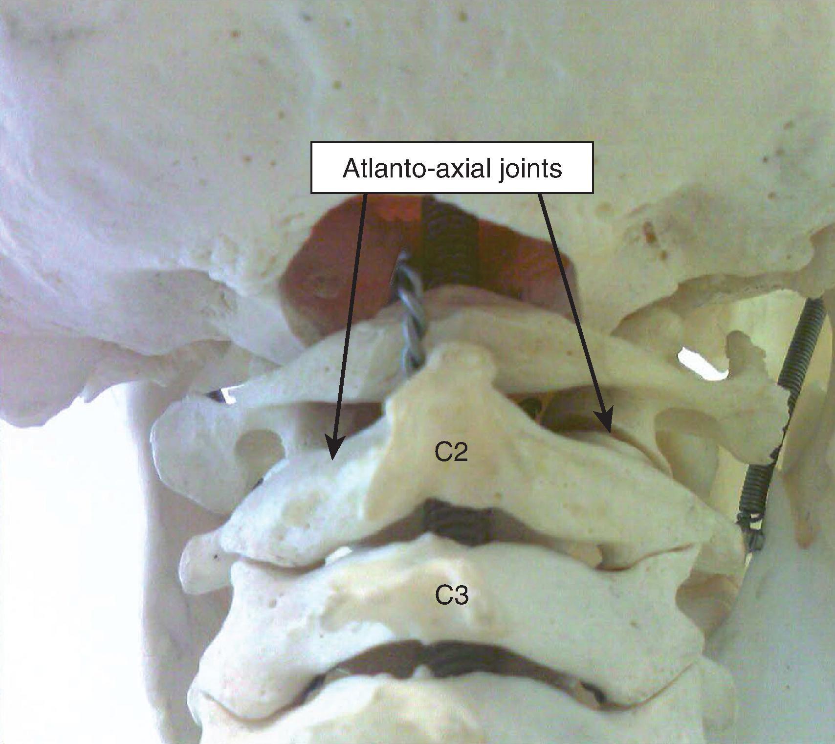 Figure 64.2, Posterior view of the atlanto-axial (C1-C2) joint. (Photo courtesy of Kenneth D. Candido, M.D.)