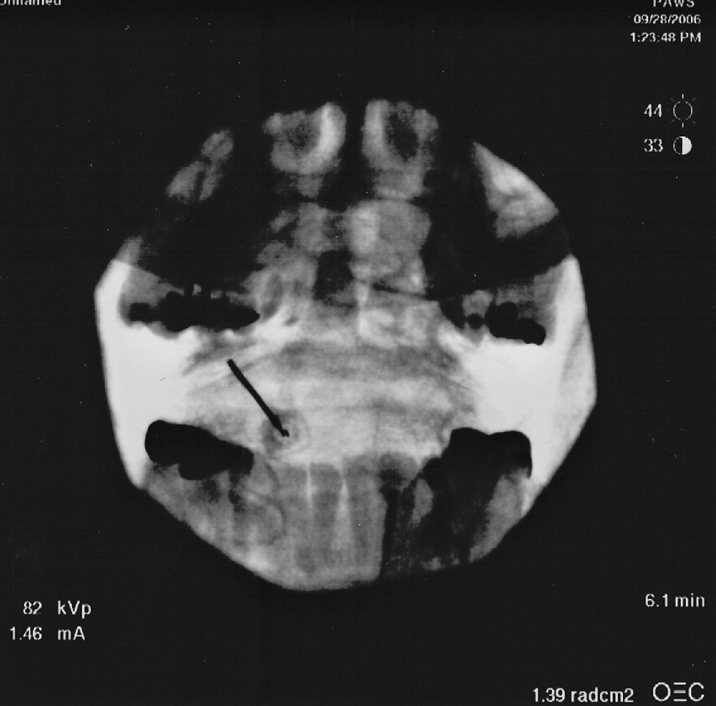 Figure 64.3, Posterior-anterior radiograph demonstrating correct needle placement using a posterior approach to the left atlanto-axial joint. (Photo courtesy of Kenneth D. Candido, M.D.)