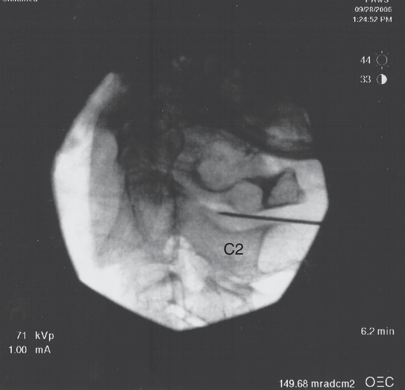 Figure 64.4, Lateral fluoroscopy demonstrating appropriate needle placement for an atlanto-axial joint injection. (Photo courtesy of Kenneth D. Candido, M.D.)