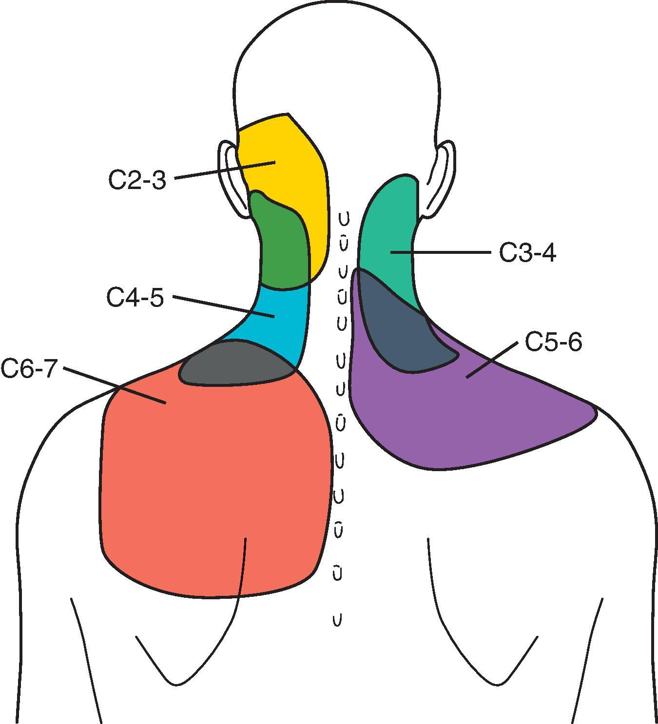 Figure 64.5, Map of areas invested by the sensory nerves of the cervical medial branches. (From Cooper G, Bailey B, Bogduk N. Cervical zygapophysial joint pain maps. Pain Med . 2007;8:344–353.)