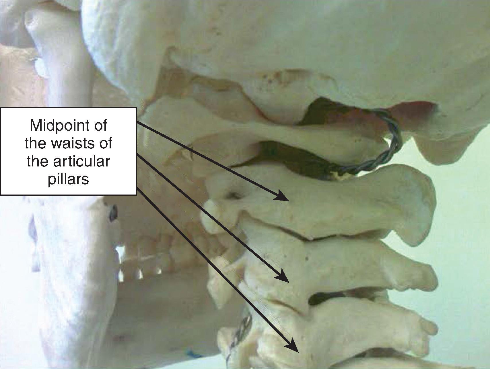 Figure 64.6, Lateral oblique view demonstrating close-up of the needle insertion points for medial branch blocks and radiofrequency ablation techniques of cervical facet joint denervation. (Photo courtesy of Kenneth D. Candido, M.D.)