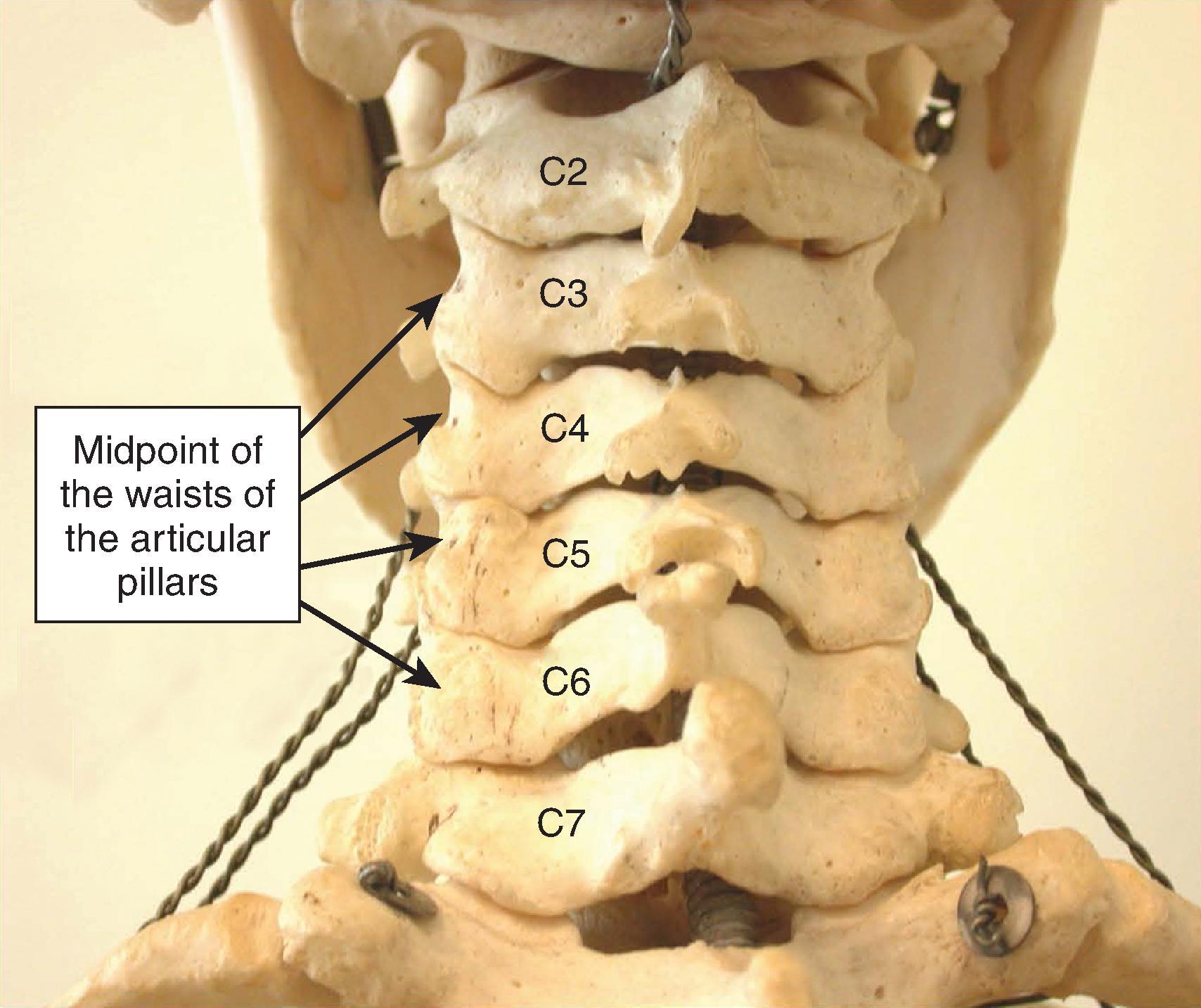 Figure 64.7, Posterior view of the scalloped areas representing the waists of the cervical articular pillars, the site of needle placement for both local anesthetic medial branch facet joint block, as well as for radiofrequency ablation procedures and pulsed radiofrequency techniques of denervating or neuromodulating the cervical facet joint nerves. The C7-T1 interlaminar opening is more capacious than more proximal levels and is the site frequently chosen for cervical epidural needle placement. (Photo courtesy of Kenneth D. Candido, M.D.)