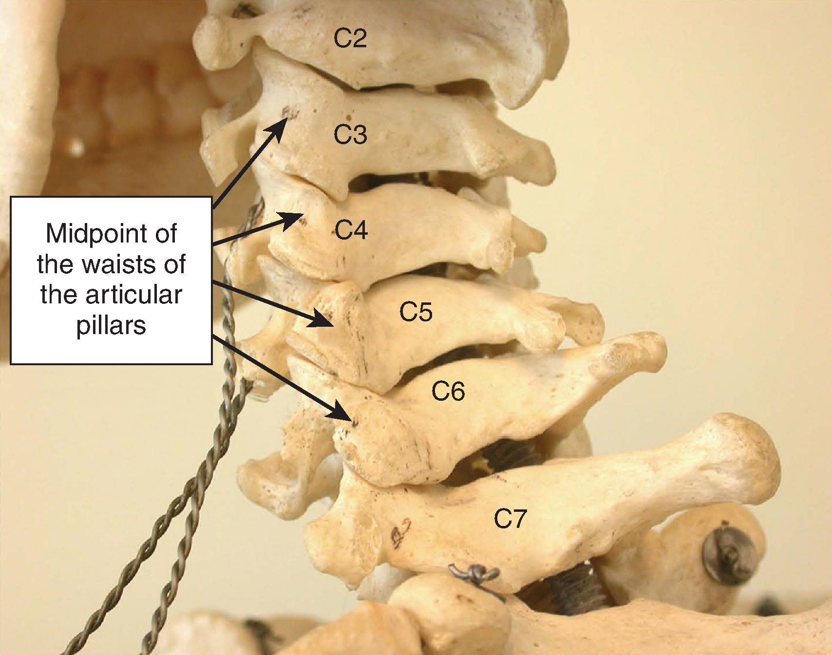 Figure 64.8, Lateral oblique view demonstrating the waists of the articular pillars in consideration of medial branch blocks of the cervical facet joints. Also demonstrated is the interlaminar space at C7–T1 for cervical epidural block needle placement. (Photo courtesy of Kenneth D. Candido, M.D.)