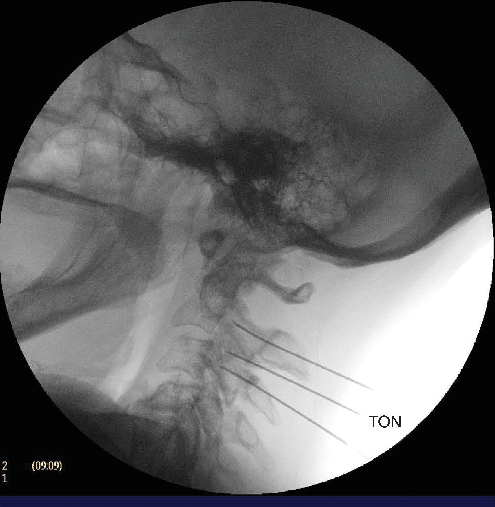 Figure 64.9, Three needles in place, lateral fluoroscopic view, for C2, C3, and third occipital nerve (TON) block, right side. (Figure courtesy of Kenneth D. Candido, M.D.)