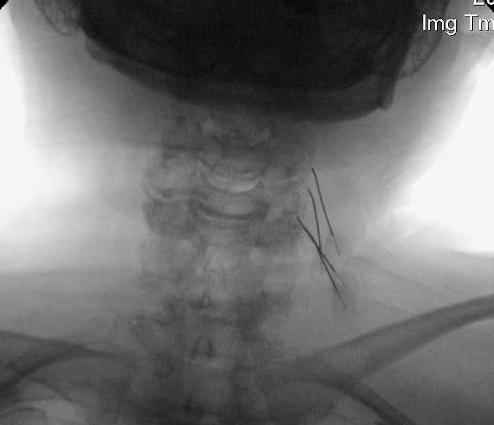 Figure 64.10, Three needles in place, anterior-posterior fluoroscopic view; right sided C2, C3, and third occipital nerve block (TON). (Photo courtesy of Kenneth D. Candido, M.D.)