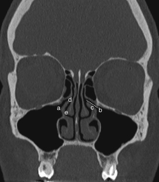 Figure 44-1, Normal paranasal sinus anatomy on CT. Coronal unenhanced CT image at level of ostiomeatal complex shows maxillary sinus ostium ( a ), infundibulum ( b, dotted line ), uncinate process ( c ), hiatus semilunaris ( d ), and middle meatus ( e ).