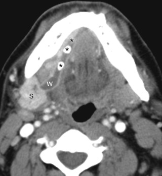 Figure 44-2, Sialolithiasis and sialoadenitis on CT. Axial contrast-enhanced CT image through floor of mouth demonstrates multiple radiodense calculi (*'s) in dilated submandibular (Wharton) duct ( w ). Right submandibular gland ( s ) is enlarged and diffusely enhances, consistent with sialoadenitis secondary to obstruction.